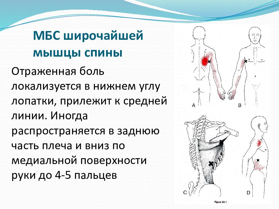 Миофасциальный болевой синдром. Широчайшая мышца спины миофасциальный синдром. Миофасциальный синдром спины. Миофасциальный болевой синдром (МБС). Миофасциальный синдром квадратной мышцы поясницы.