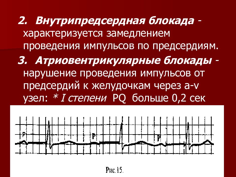 Внутрипредсердная проводимость