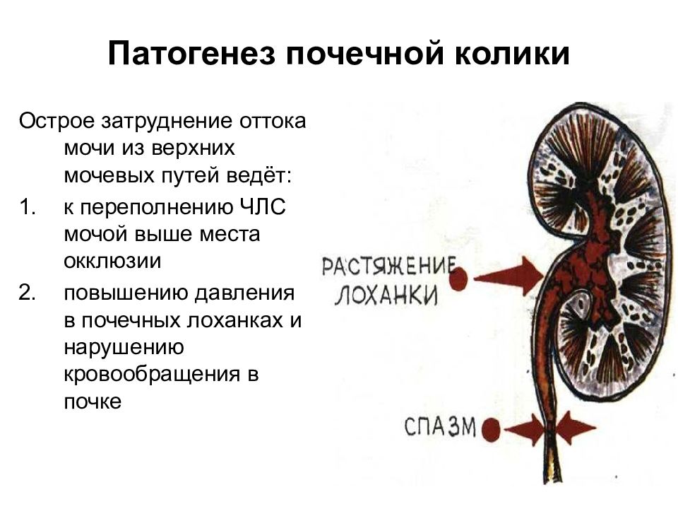 Члс почек. Почечная колика этиология. Механизм развития почечной колики. Почечная колика этиология патогенез. Патогенез мочекаменной болезни почек.