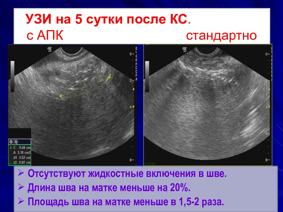 После мм. УЗИ после кесарева сечения. Шов на матке после кесарева заключение УЗИ.