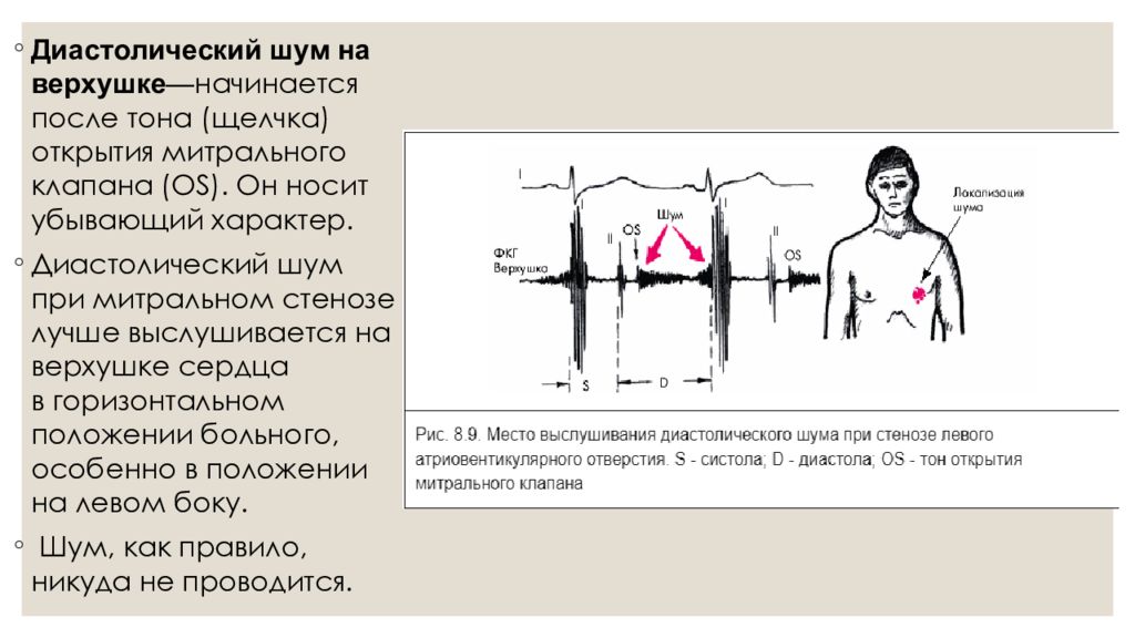 Аускультативная картина при митральном стенозе сердца включает тест