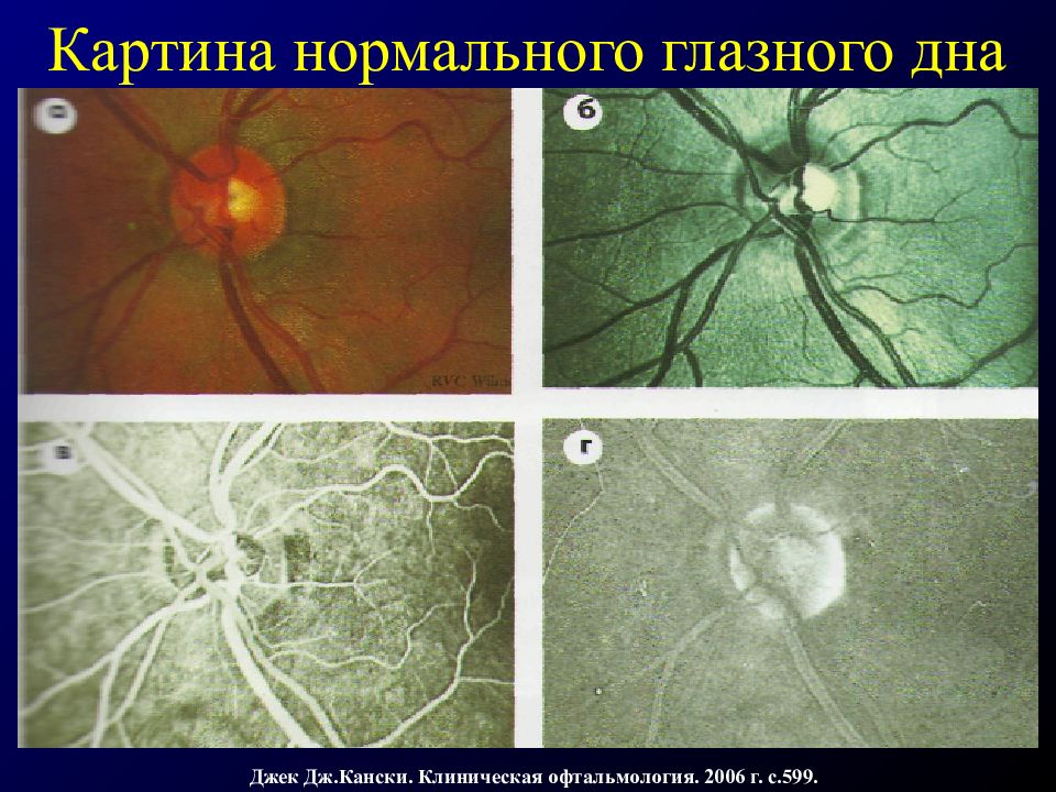 Картина нормального глазного дна