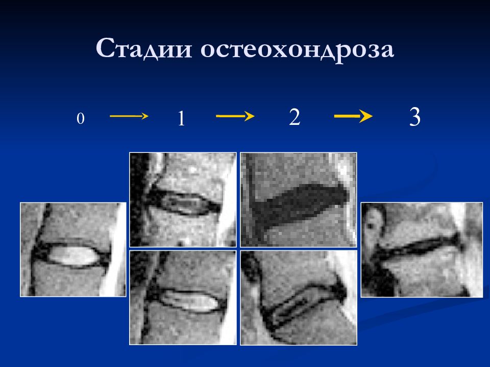 Степени остеохондроза. Стадии остеохондроза. Этапы остеохондроза. Остеохондроз классификация по стадиям. Фазы остеохондроза.