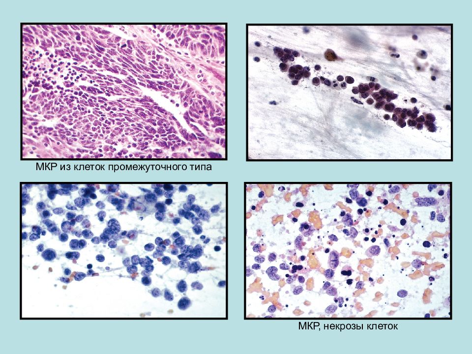 Промежуточный клеточный тип. Цитологическая диагностика. Цитологическое исследование щитовидки. Цитологическое исследование легких. Цитологическая диагностика заболеваний молочной железы.