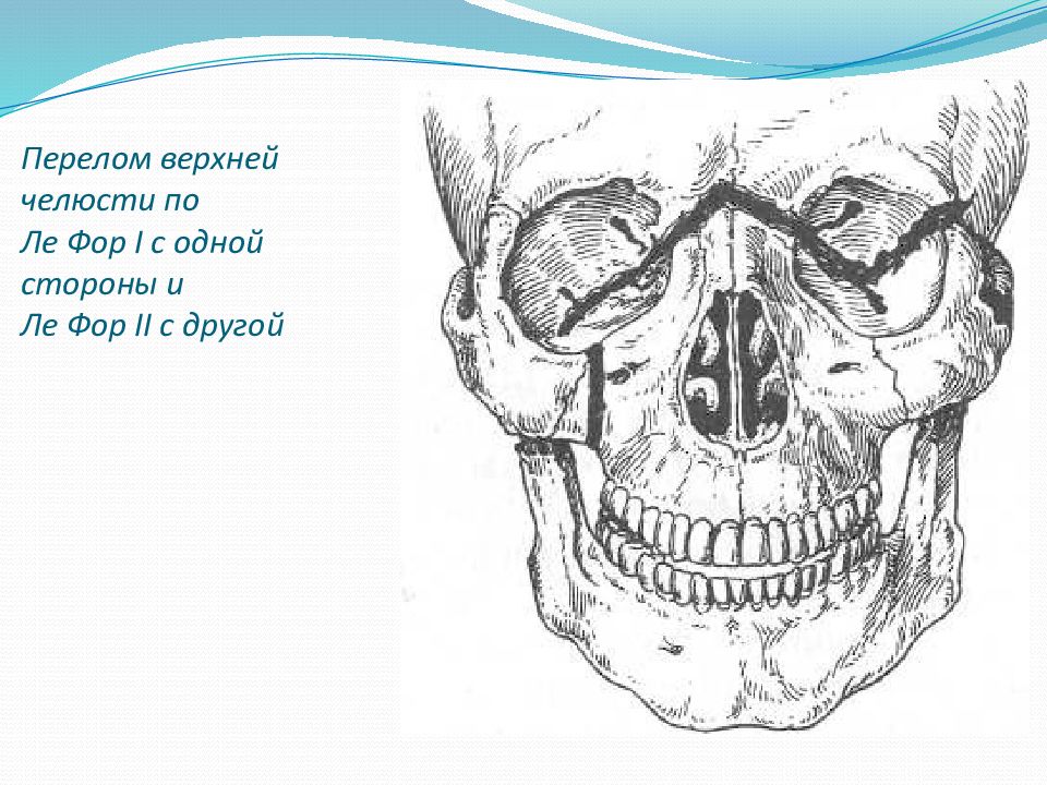 Перелом верхней челюсти. Переломы верхней челюсти презентация. Череп человека перелом верхней челюсти. Перелом верхней челюсти картинки.