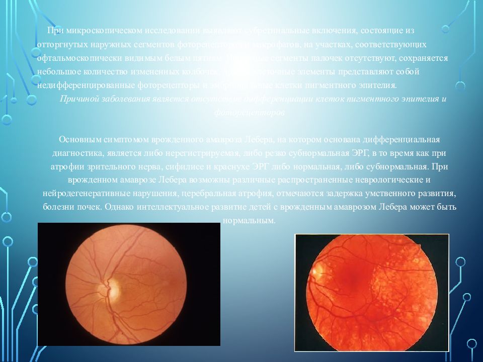 Заболевания сетчатки и зрительного нерва офтальмология презентация