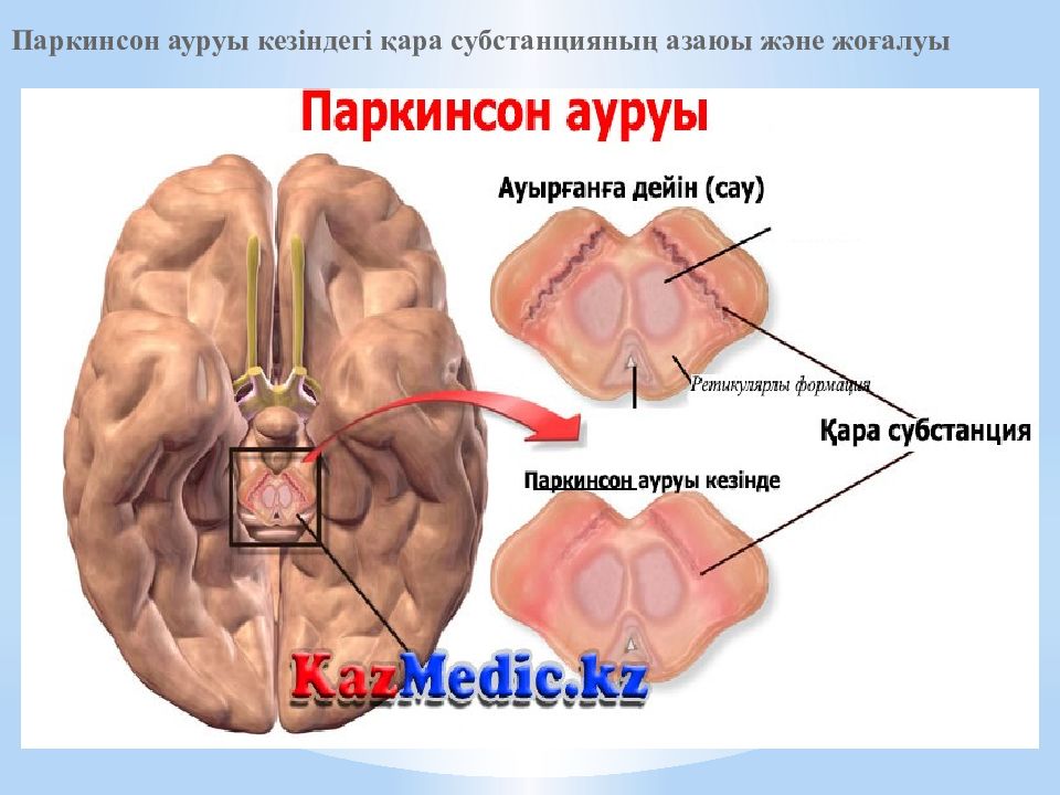 Паркинсон ауруы презентация