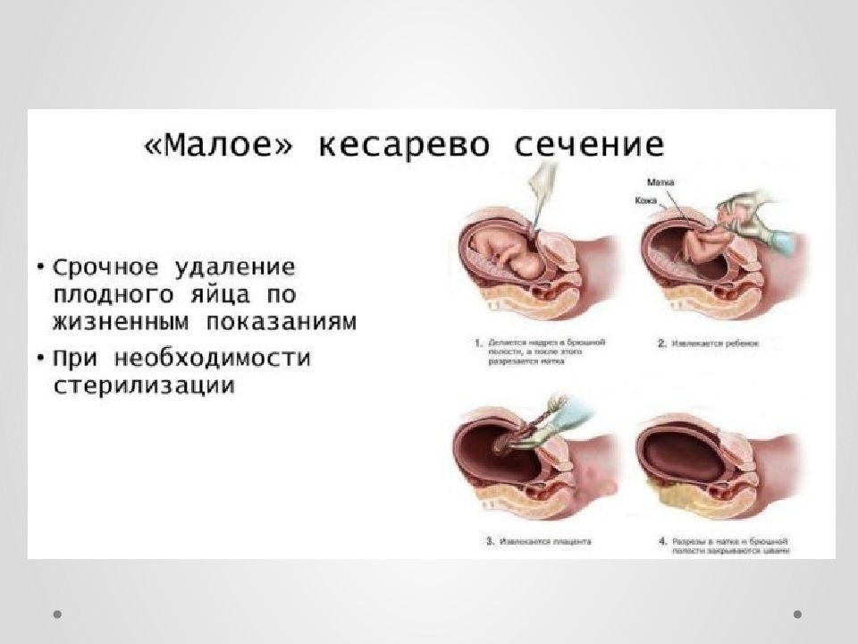 Сечение матки операция. Малое кесарево сечение. Малое кесарево сечение аборт. Кесарево при беременности.