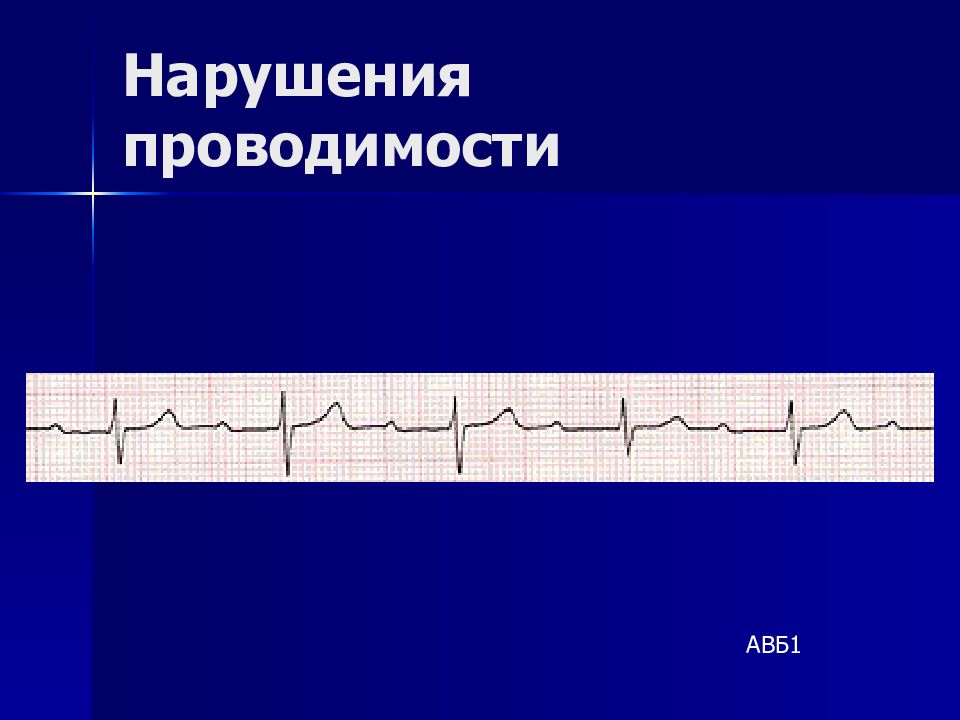 Нарушение проводимости. Нарушение проводимости на ЭКГ. AVF нарушение проводимости. Оценка функции проводимости на ЭКГ. Нарушения проводимости презентация.