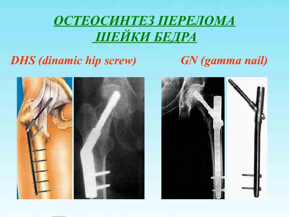 Операция остеосинтез шейки бедра. Остеосинтез проксимального отдела бедренной кости. Экстрамедуллярный остеосинтез. Остеосинтез перелома бедренной кости. Перелом шейки бедра интрамедуллярный остеосинтез.