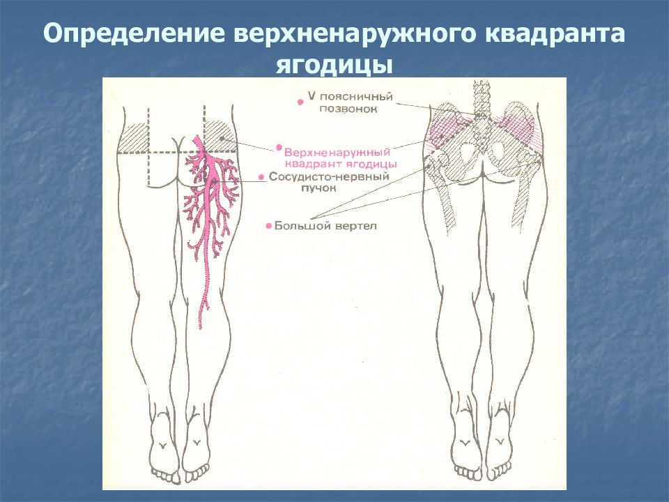 Схема для внутримышечных уколов