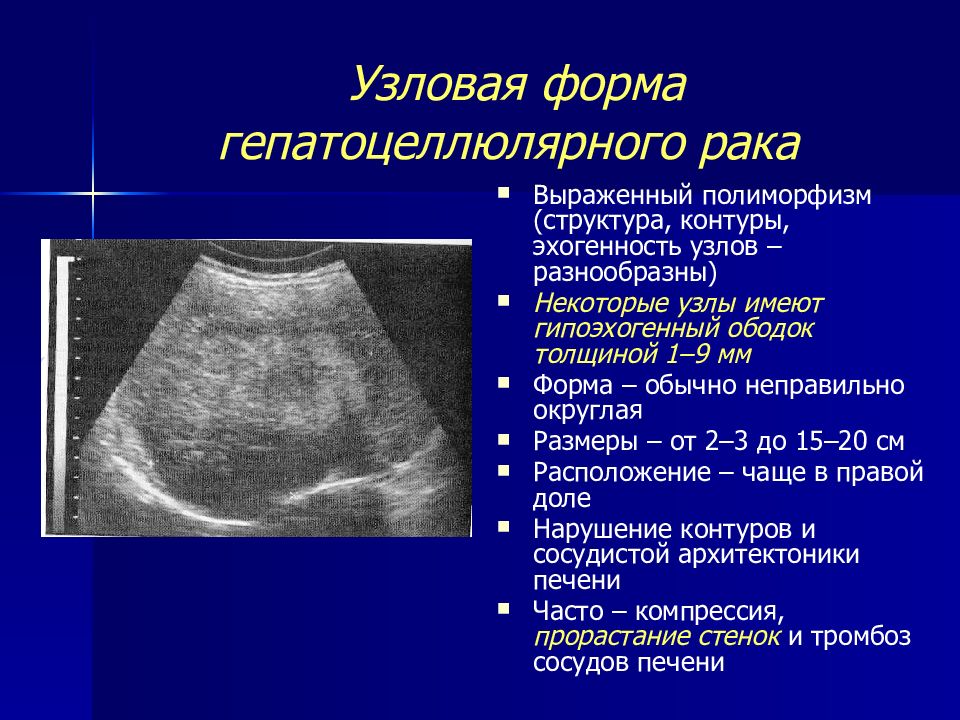 Эхографическая картина первичного рака печени характеризуется