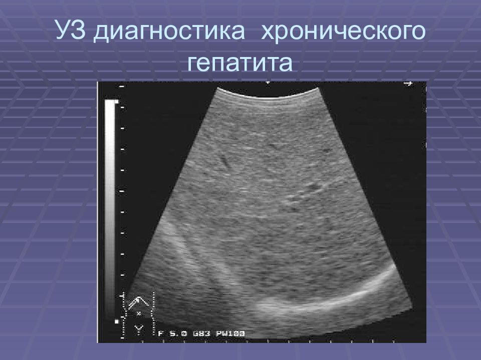 Узи картина. Хронический гепатит на УЗИ. УЗИ печени. УЗИ печени хронический гепатит.