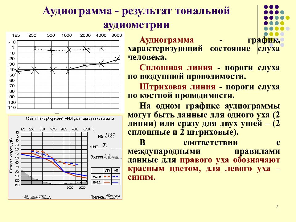 Аудиограмма в норме рисунок