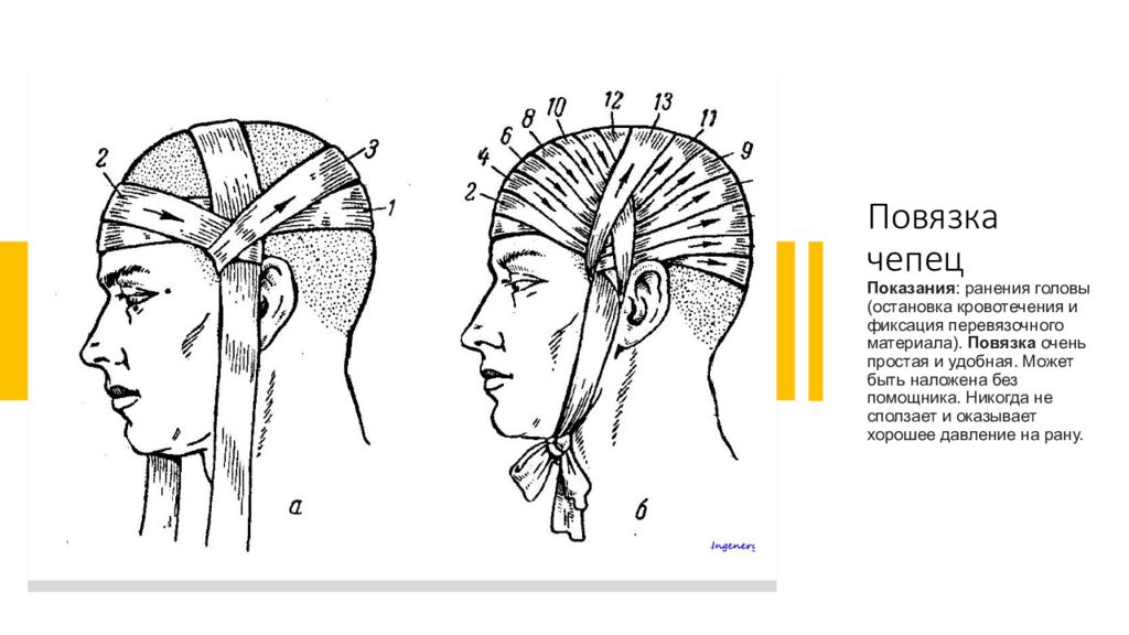 Техника наложения повязки чепец. Схема наложения повязки чепец. Перевязка головы чепец. Десмургия повязка чепец. Схема перевязки головы чепец.