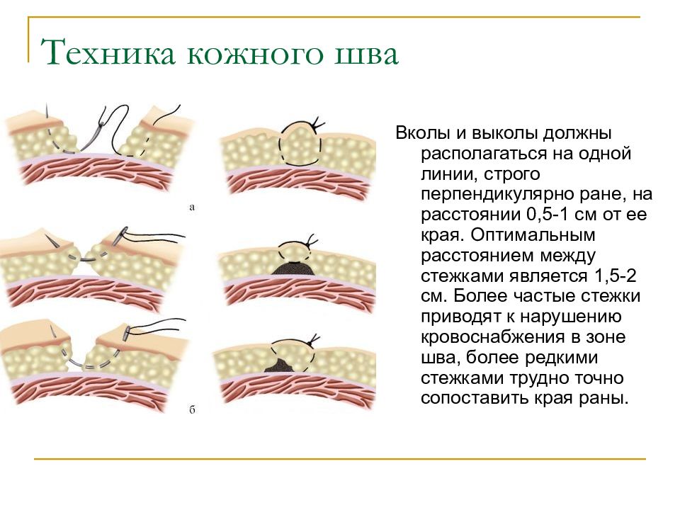 Соединение тканей. Техника снятия кожных швов. Хирургические швы на поверхностных тканях.