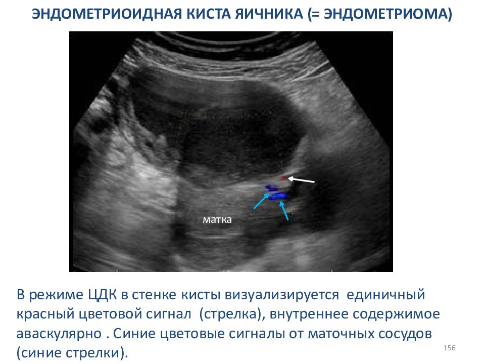 Эндометриозная киста. Эндометриоидная киста яичника. Эндометриоидная киста брюшины. Эндометриоидная киста яичников.