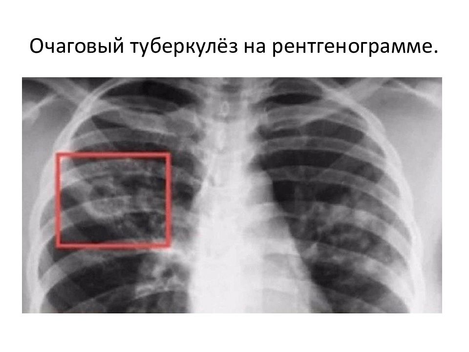 Через легкого. Очаговый туберкулез рентгенограмма. Милиарный туберкулез рентген. Бруцеллезная пневмония. Фридлендеровская пневмония.