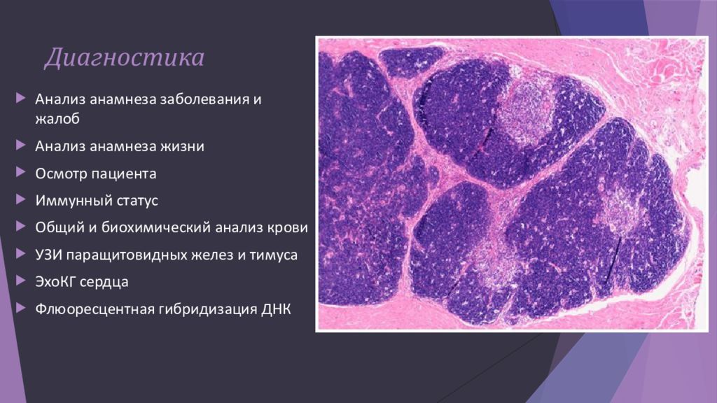 Синдром ди джорджи. Гипоплазия тимуса (синдром ди Джорджи). Синдром ди Джорджи гистология. Синдром ди Джорджи тимус. Синдром ди Джорджи патанатомия.