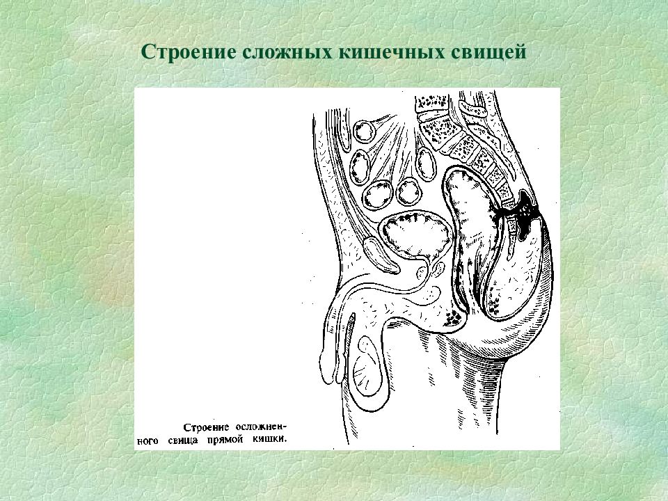 Свищ это простыми словами. Тонкокишечные свищи классификация. Кишечный свищ строение. Кишечные свищи классификация.