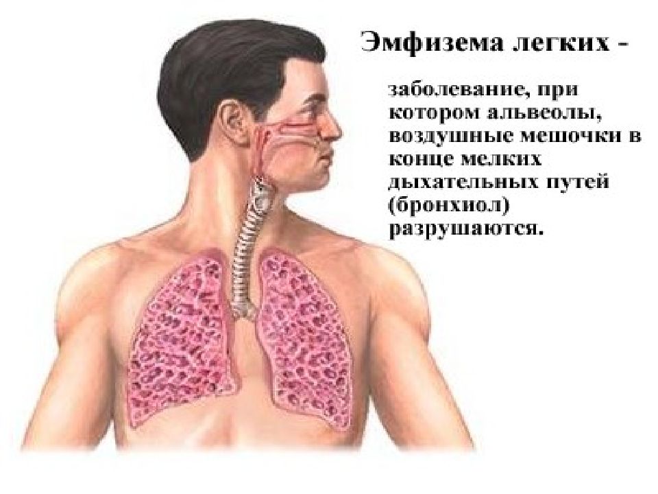 Легко ли вылечить. Экспираторная эмфизема.