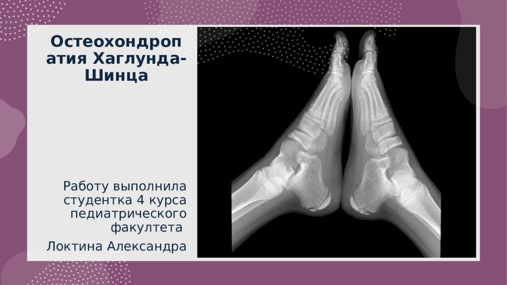 Остеохондропатия Хаглунда - Шинца