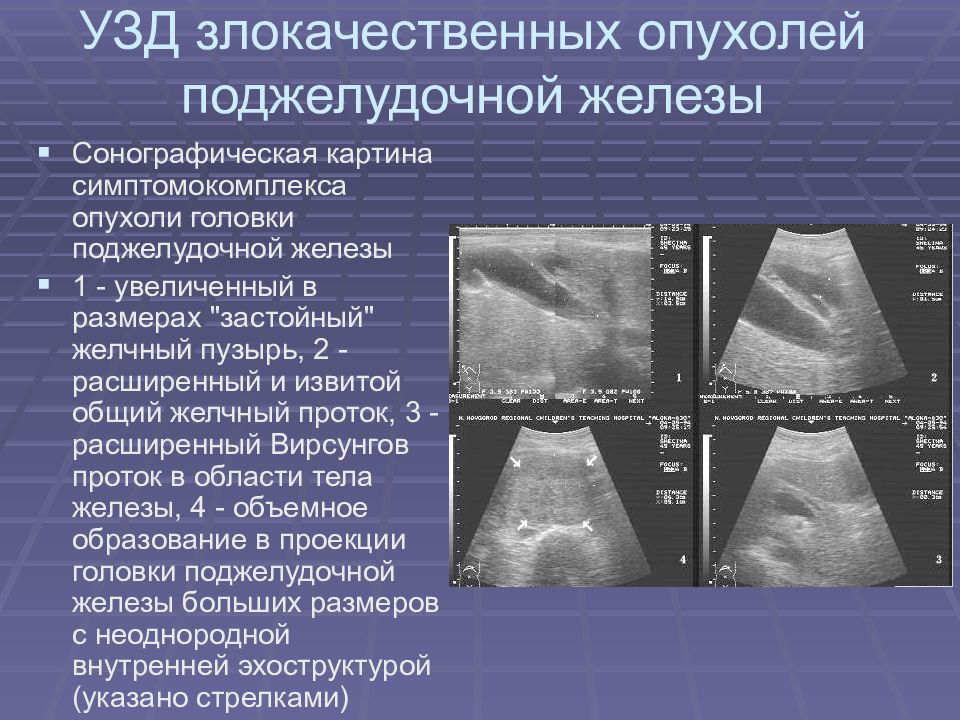 Эхографическое изображение злокачественной опухоли чаще представляет собой образование