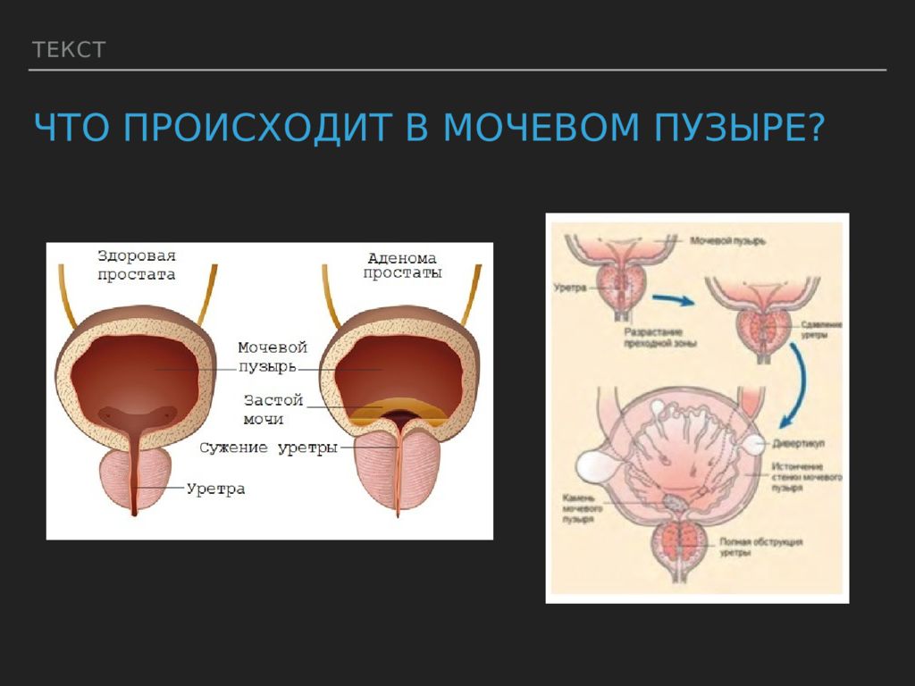 Увеличение предстательной железы. Строение простаты. Увеличенная предстательная железа. Простата анатомия.