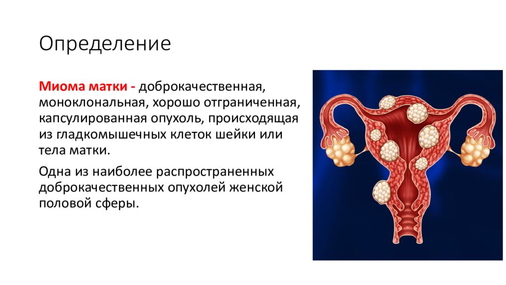 Что такое миома. Миома матки доброкачественная моноклональная. Миома матки шеечная локализация. Корпоральная миома матки. Локализация миом тела матки:.