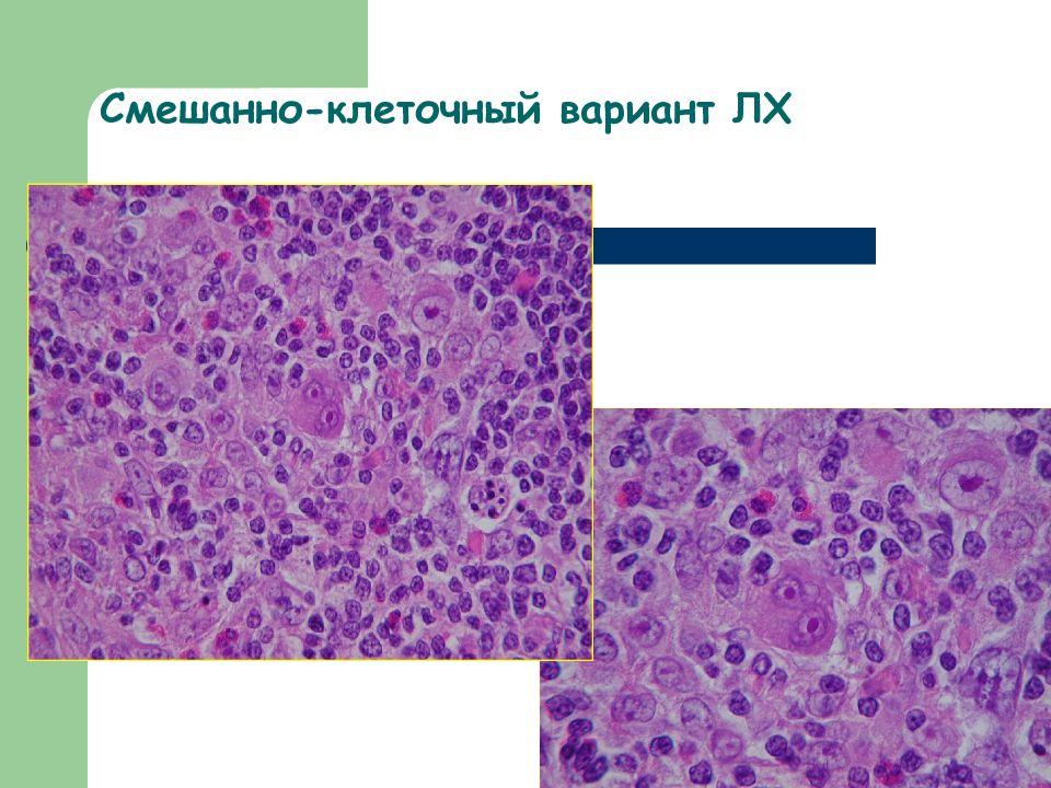 Патологическая анатомия презентации. Смешанно-клеточный вариант. Осложнения гемобластозов.