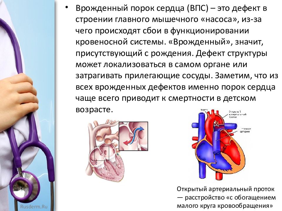 Пороки сердца впс