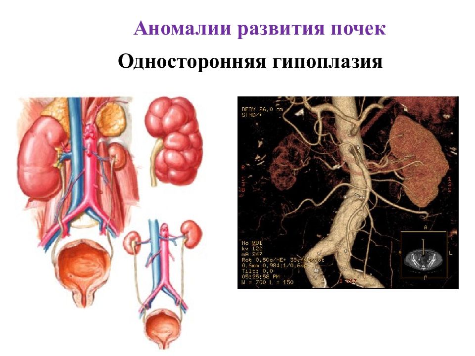 Аномалия развития почек презентация