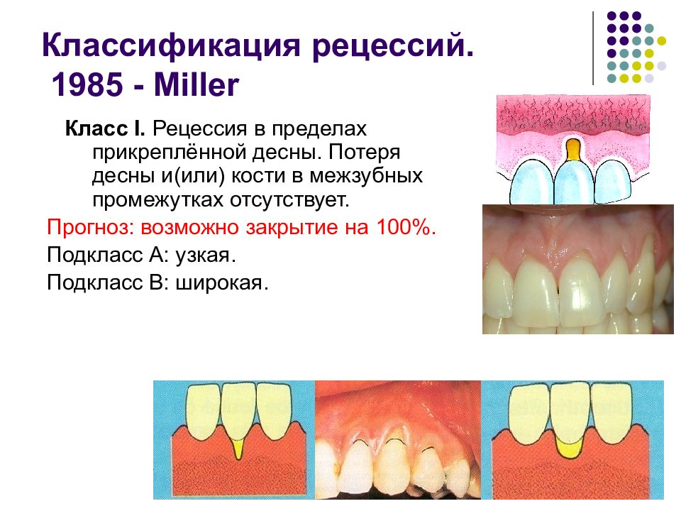 Классификация миллера. Классификация Миллера рецессии десны. Классификация рецессии десны по Миллеру. Классификация рецессий по Miller. Классификация Miller рецессия десны.