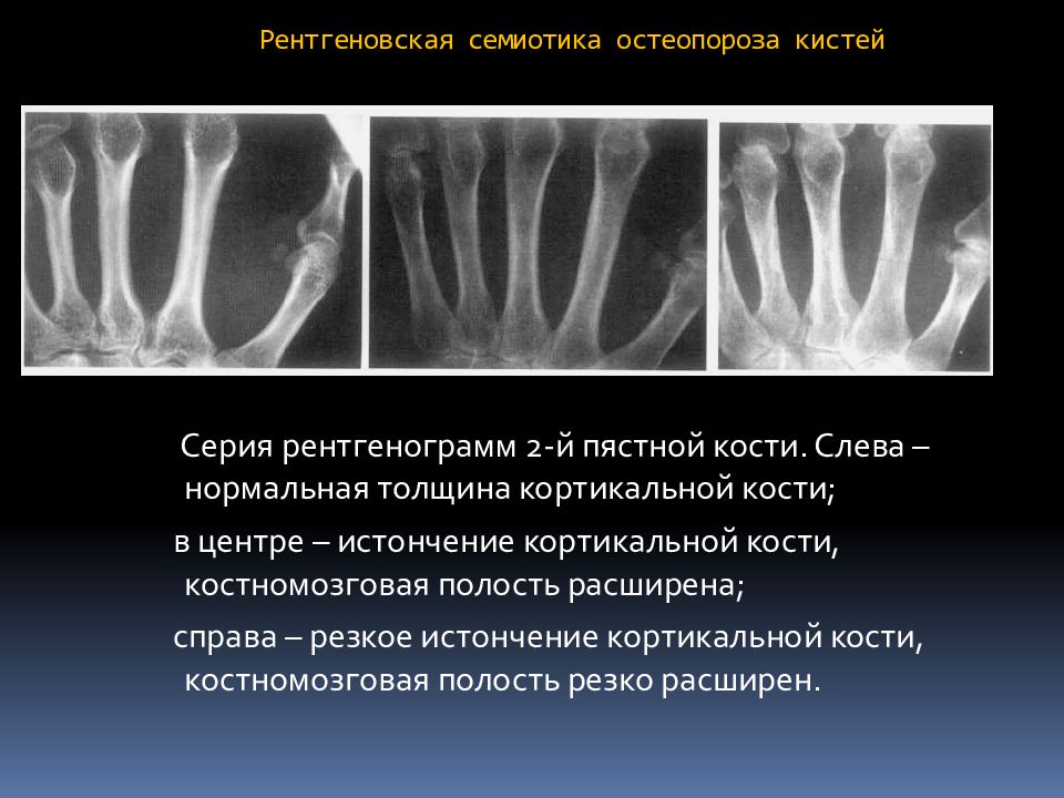 Анализ кости на остеопороз