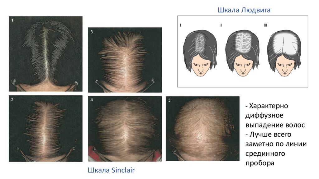 Лечение диффузной алопеции у женщин препараты схема
