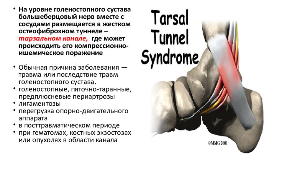 Невропатия нижних конечностей симптомы. Туннельные невропатии нижних конечностей. Тарзальный туннельный синдром. Большеберцовый туннельный синдром. Тарзальный канал большеберцового нерва.