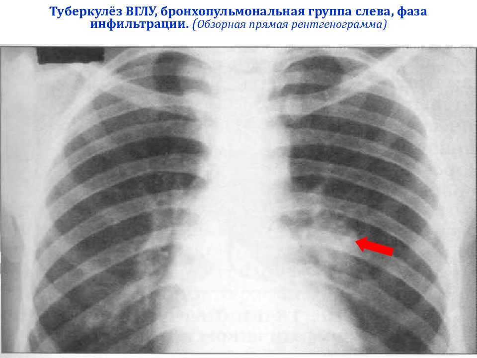 Внутригрудные лимфатические узлы. Туберкулез внутригрудных лимфоузлов рентген. Инфильтративный бронхоаденит рентген. Туберкулез внутригрудных узлов рентген. Туберкулез внутригрудных лимфатических узлов у детей рентген.