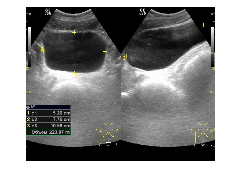 Узи мочевого пузыря презентация