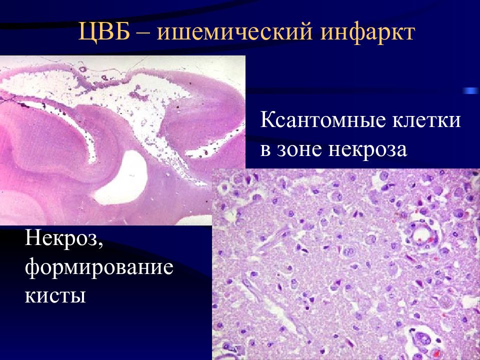 Ибс патологическая анатомия презентация