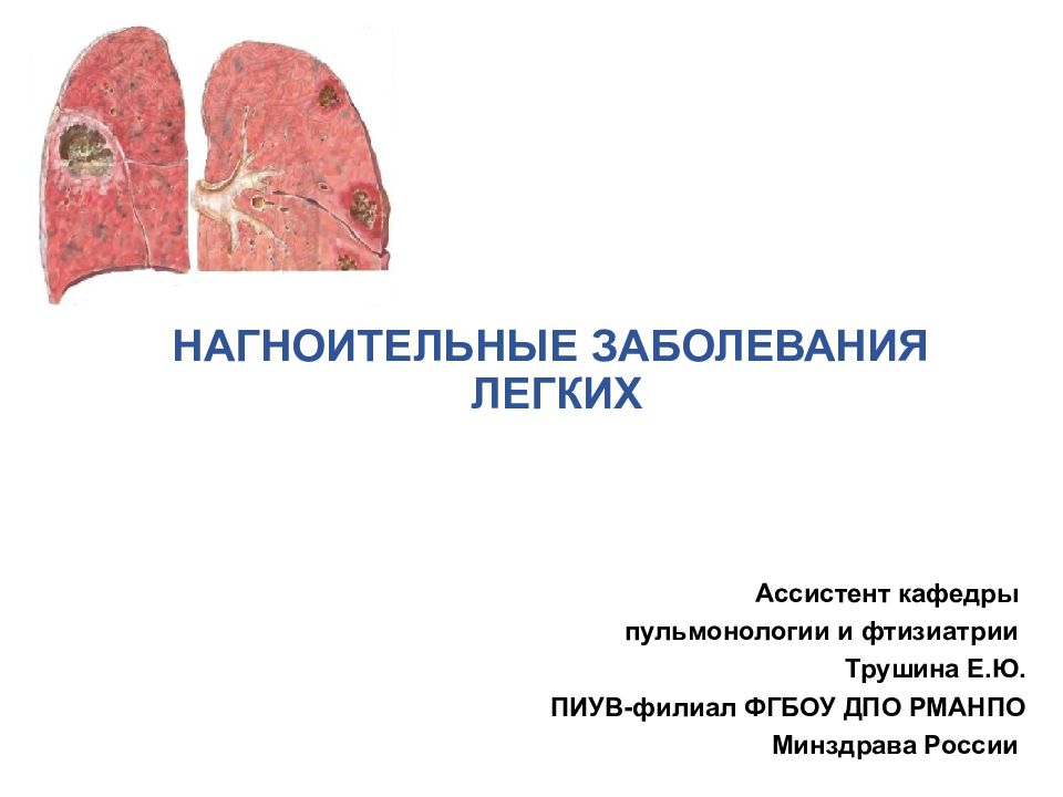 Инфекция легких. Нагноительные заболевания легких.