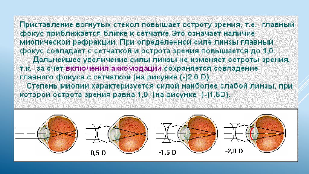Сложный гиперметропический астигматизм глаз. Исследование рефракции зрения метод. Астигматизм рефракция аккомодация. Сложный миопический астигматизм типы. Гиперметропия 1 степени миопический астигматизм.