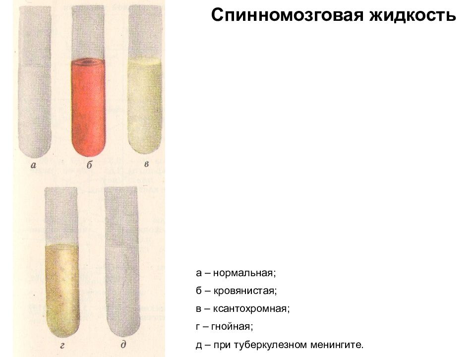 Цереброспинальная жидкость при менингитах. СМЖ при туберкулезном менингите. Спинномозговая жидкость при туберкулезном менингите. Спинномозговая жидкость при туберкулезном менингите выглядит как. Цереброспинальная жидкость при туберкулезном менингите.