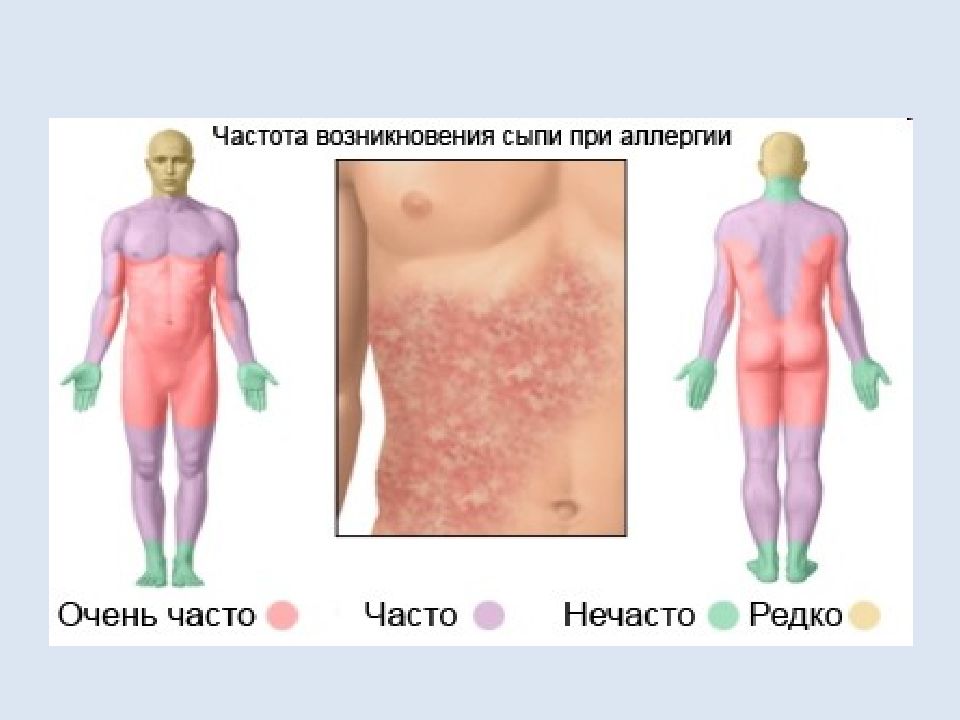 Генерализованная крапивница карта вызова