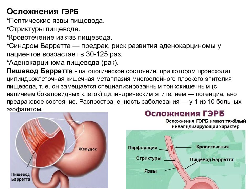 Рефлюксная болезнь презентация