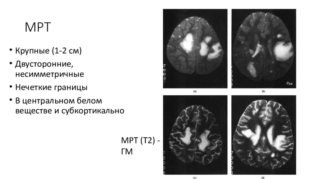 Острый рассеянный энцефаломиелит презентация