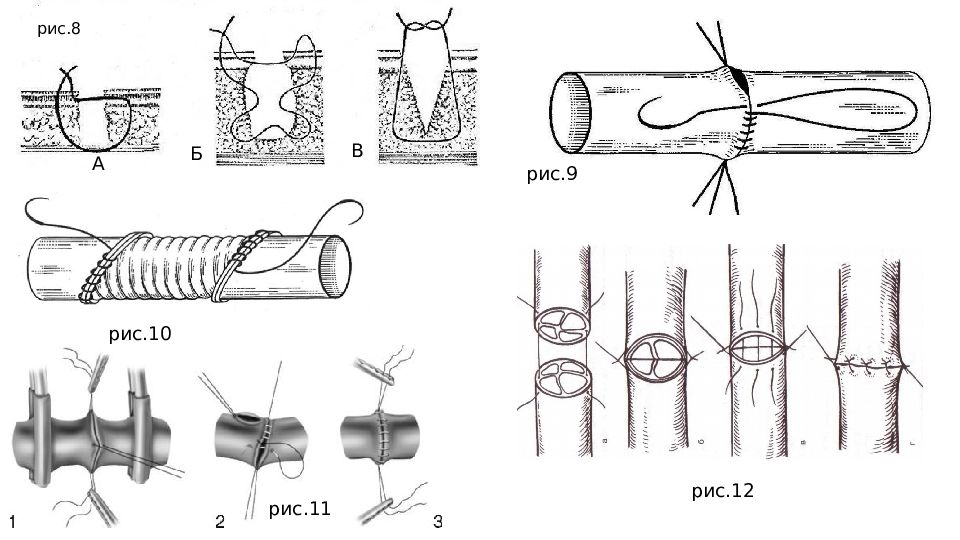 Виды хирургических швов презентация