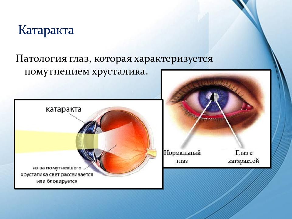 Заболевания глаз биология 8. Заболевание глаз катаракта. Презентация заболевания глаз. Заболевания глаз доклад.