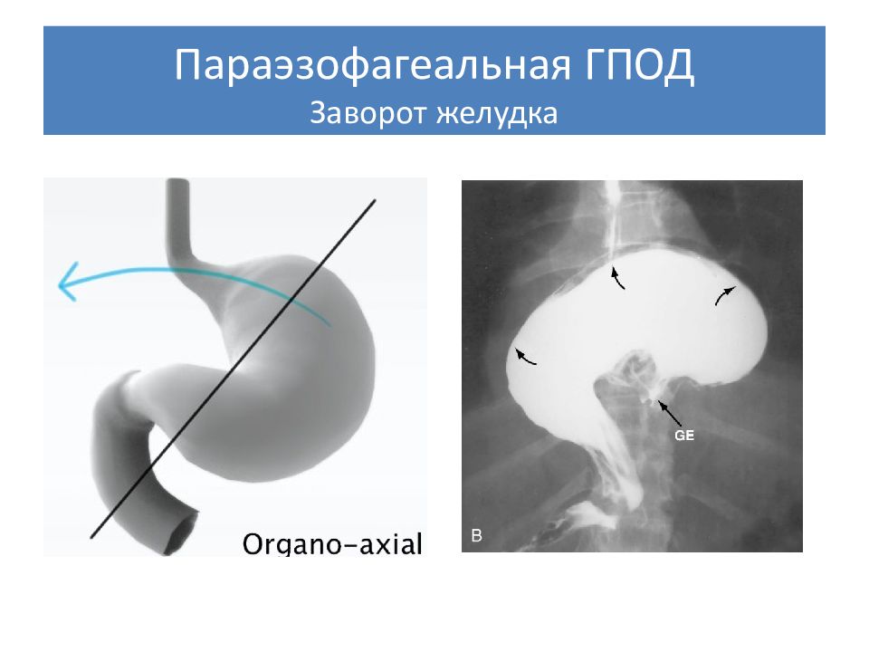 Эндоскопическая картина при грыжах пищеводного отверстия диафрагмы характеризуется