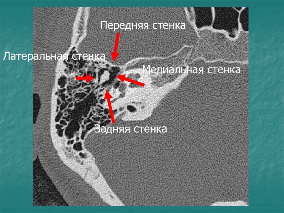 Пирамида височной кости кт