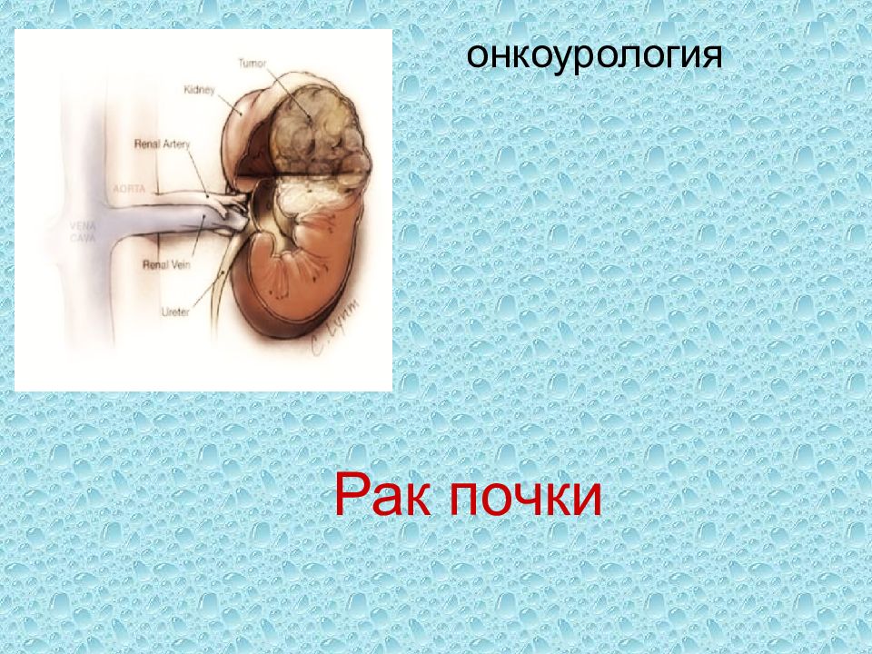 Рак почки
